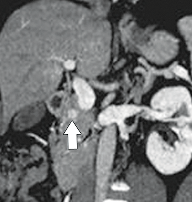 Gastroenteropancreatic Neuroendocrine Tumors: Role of Imaging in Diagnosis and Management
